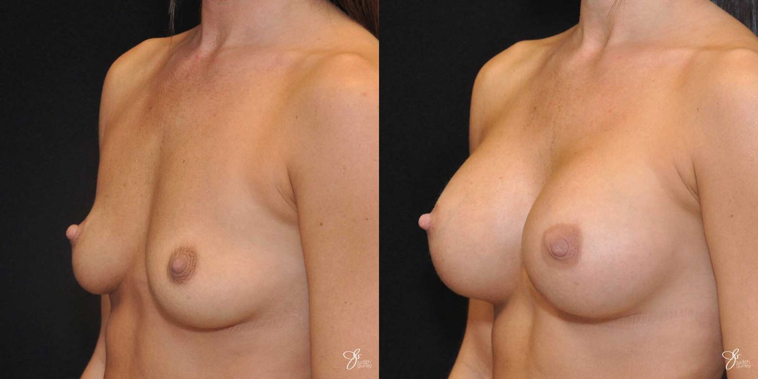 Breast Augmentation Before & After