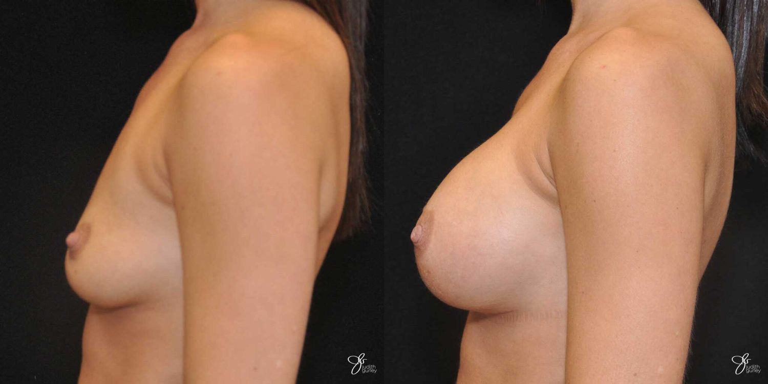 Breast Augmentation Before & After
