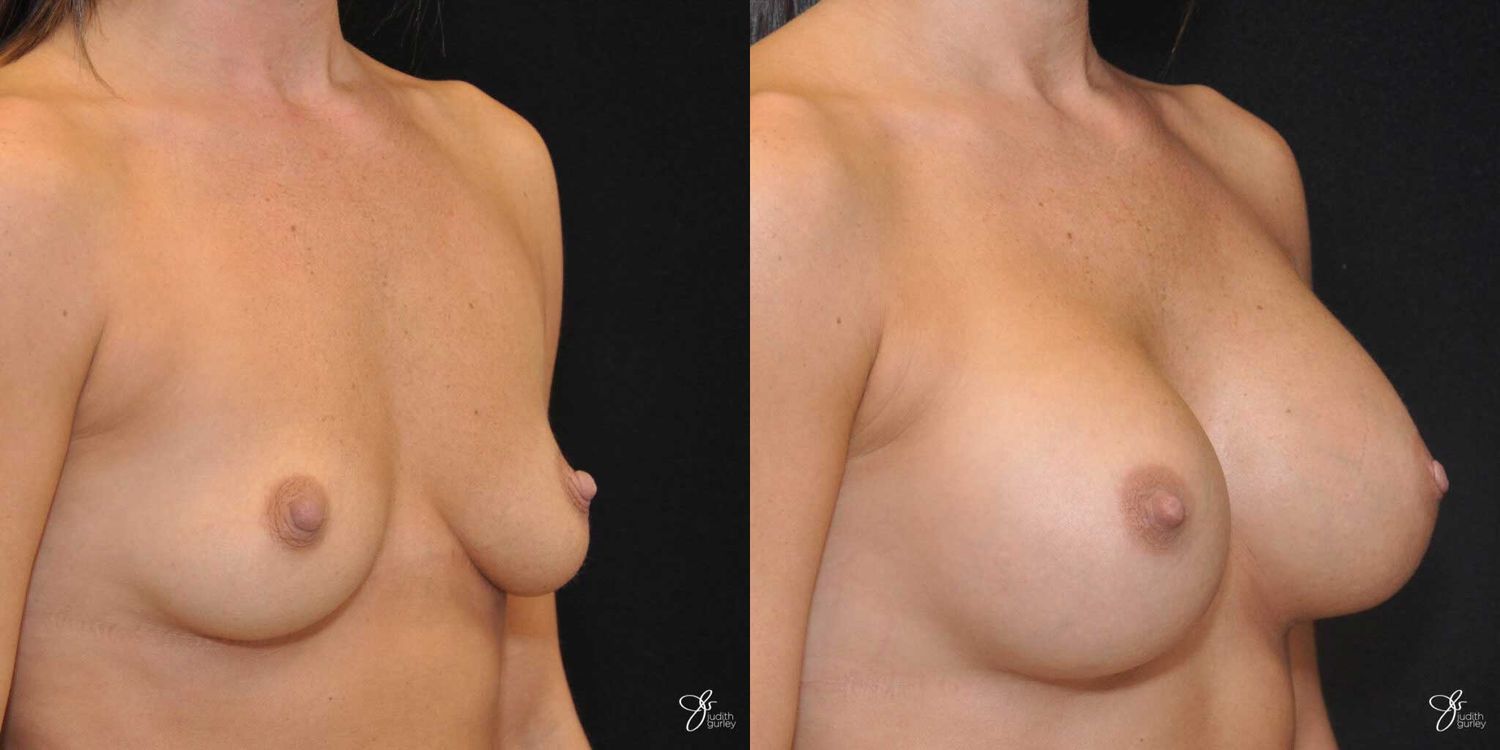 Breast Augmentation Before & After