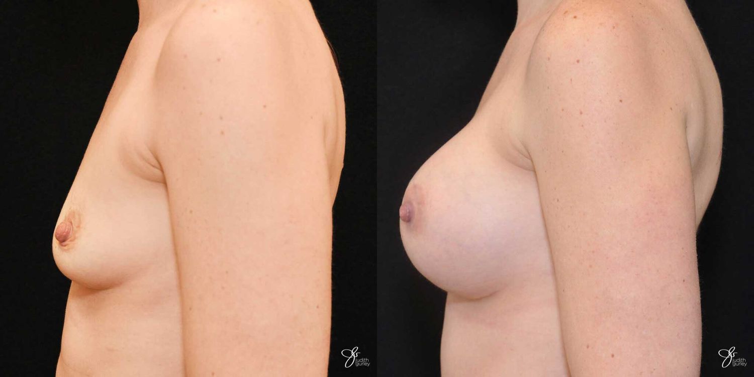 Breast Augmentation Before & After