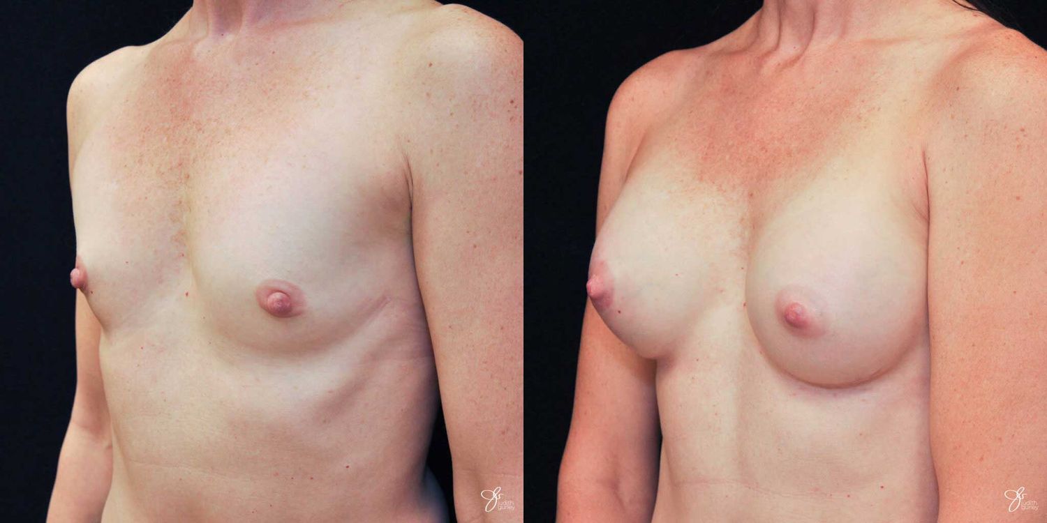Breast Augmentation Before & After