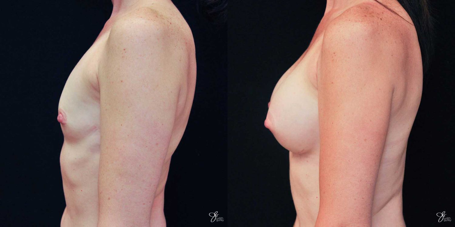 Breast Augmentation Before & After