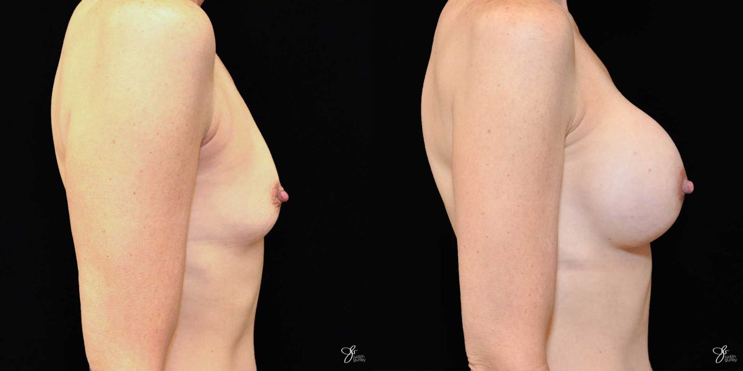 Breast Augmentation Before & After