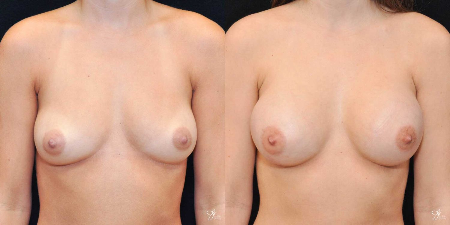 Breast Augmentation Before & After