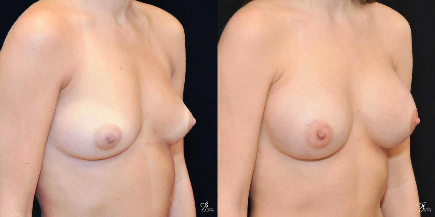 Breast Augmentation Before & After