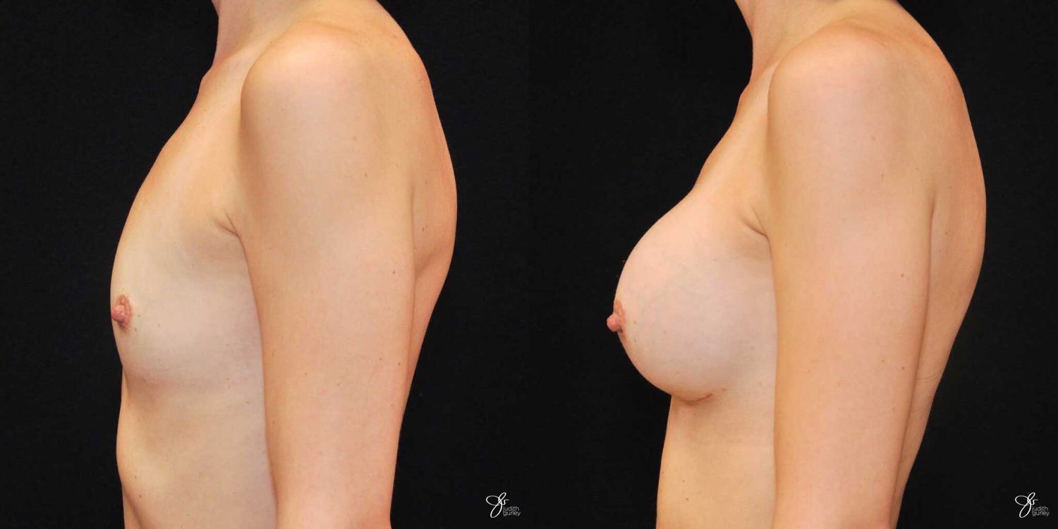 Breast Augmentation Before & After