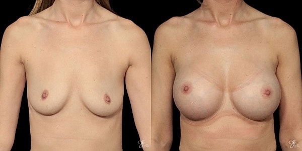 Breast Augmentation Before & After