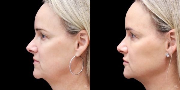 Facial Rejuvenation Before & After