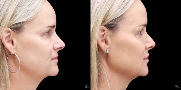 Facial Rejuvenation Before & After