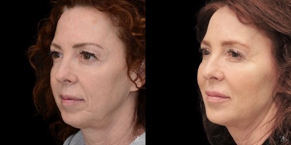 Facial Rejuvenation Before & After