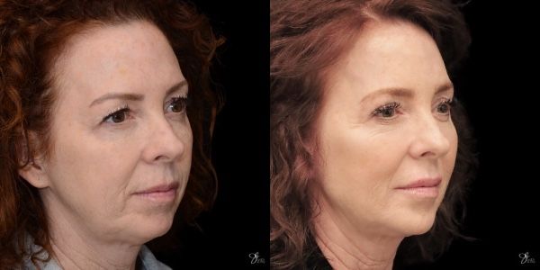 Facial Rejuvenation Before & After