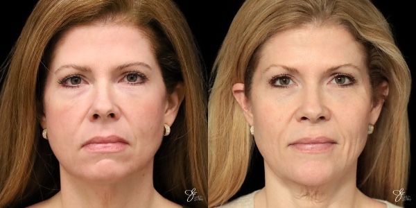 Facial Rejuvenation Before & After