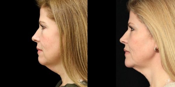 Facial Rejuvenation Before & After