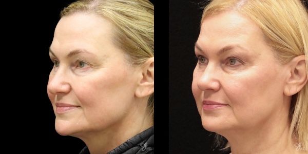 Facial Rejuvenation Before & After
