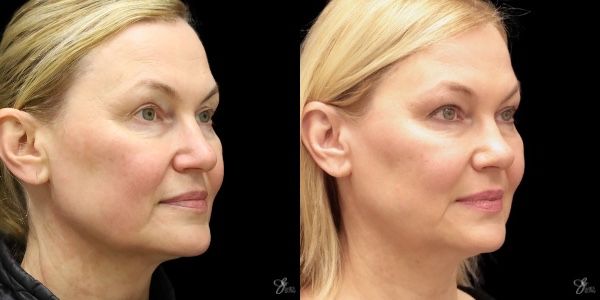 Facial Rejuvenation Before & After