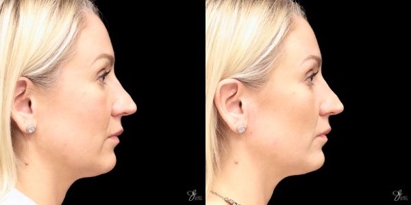 Facial Rejuvenation Before & After