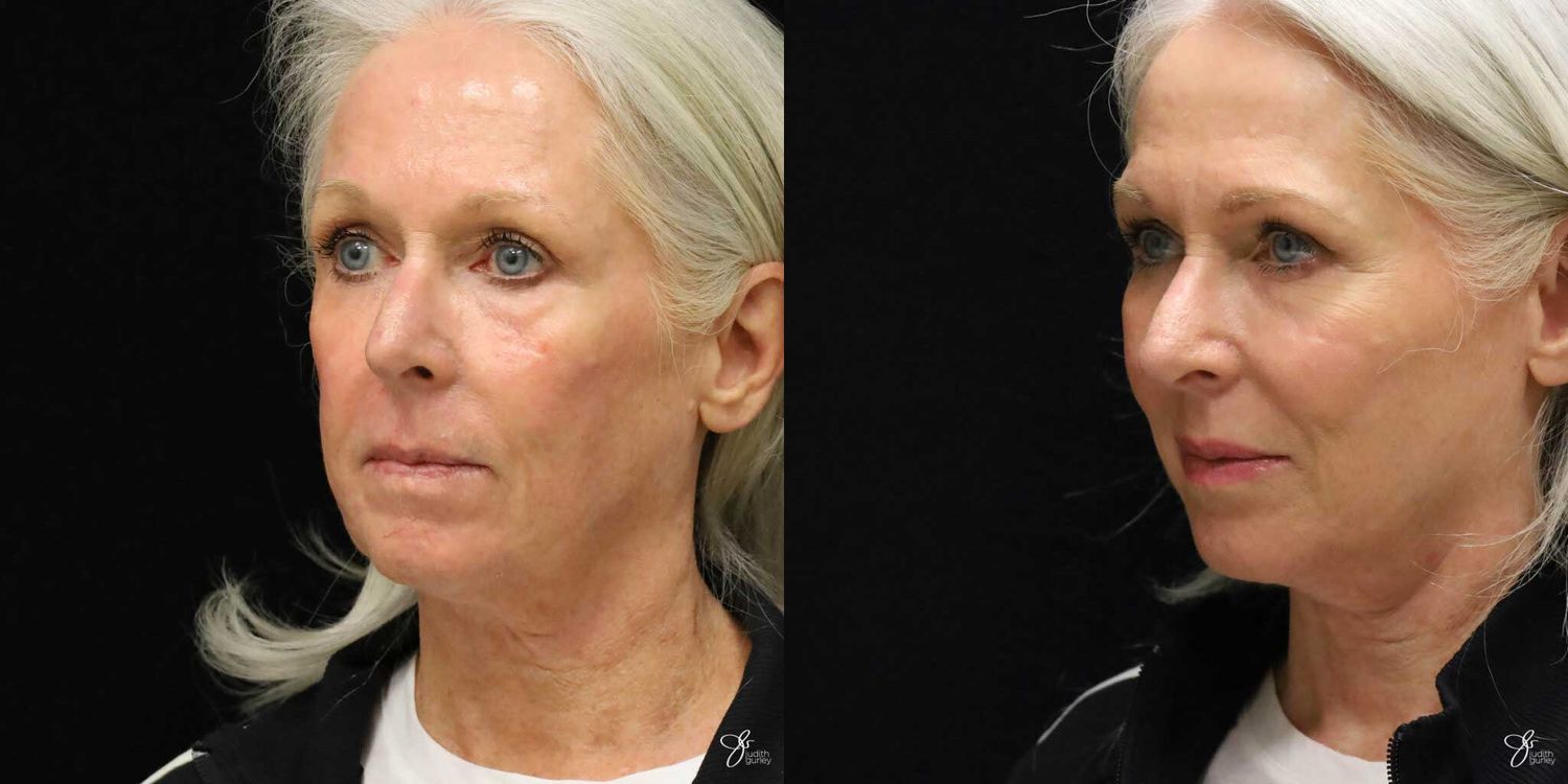 Facial Rejuvenation Before & After