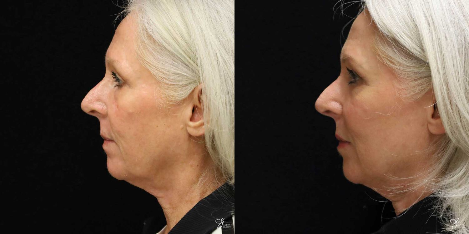 Facial Rejuvenation Before & After