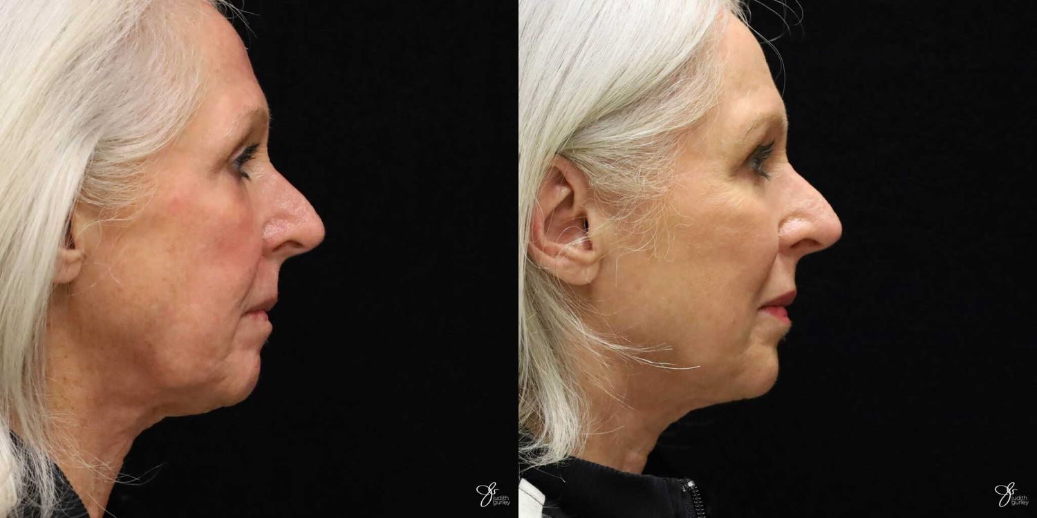 Facial Rejuvenation Before & After