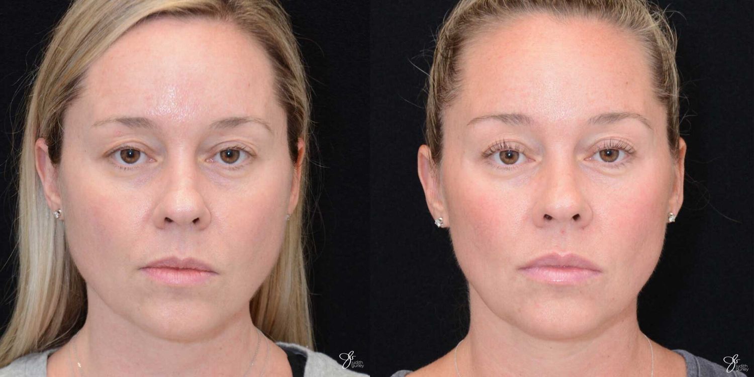 Facial Rejuvenation Before & After