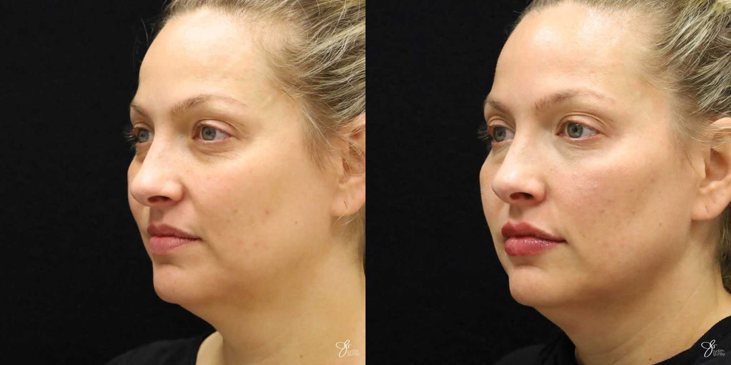 Facial Rejuvenation Before & After