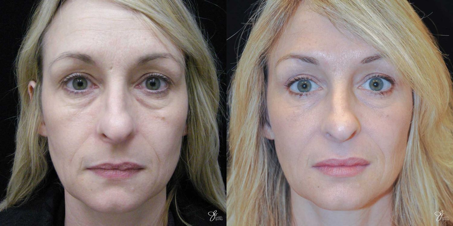 Facial Rejuvenation Before & After