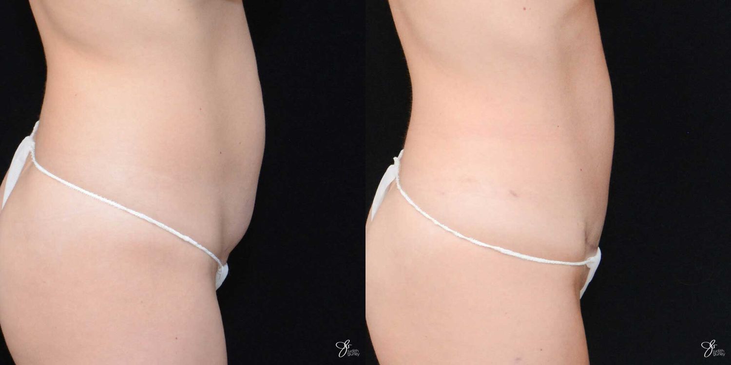 C Section Scar Correction Before & After