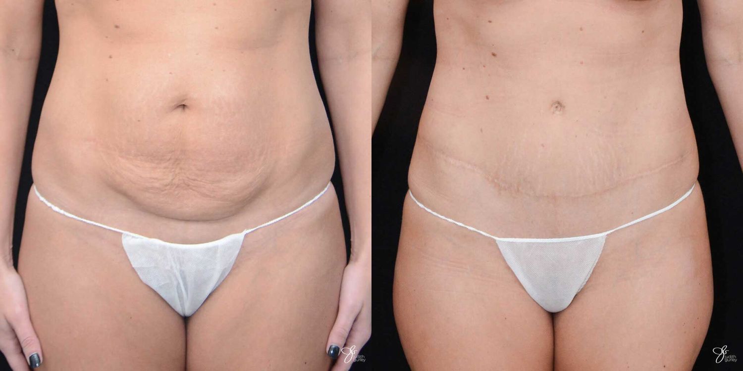 C Section Scar Correction Before & After