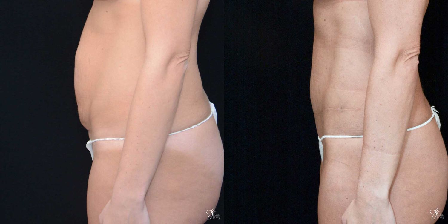 C Section Scar Correction Before & After