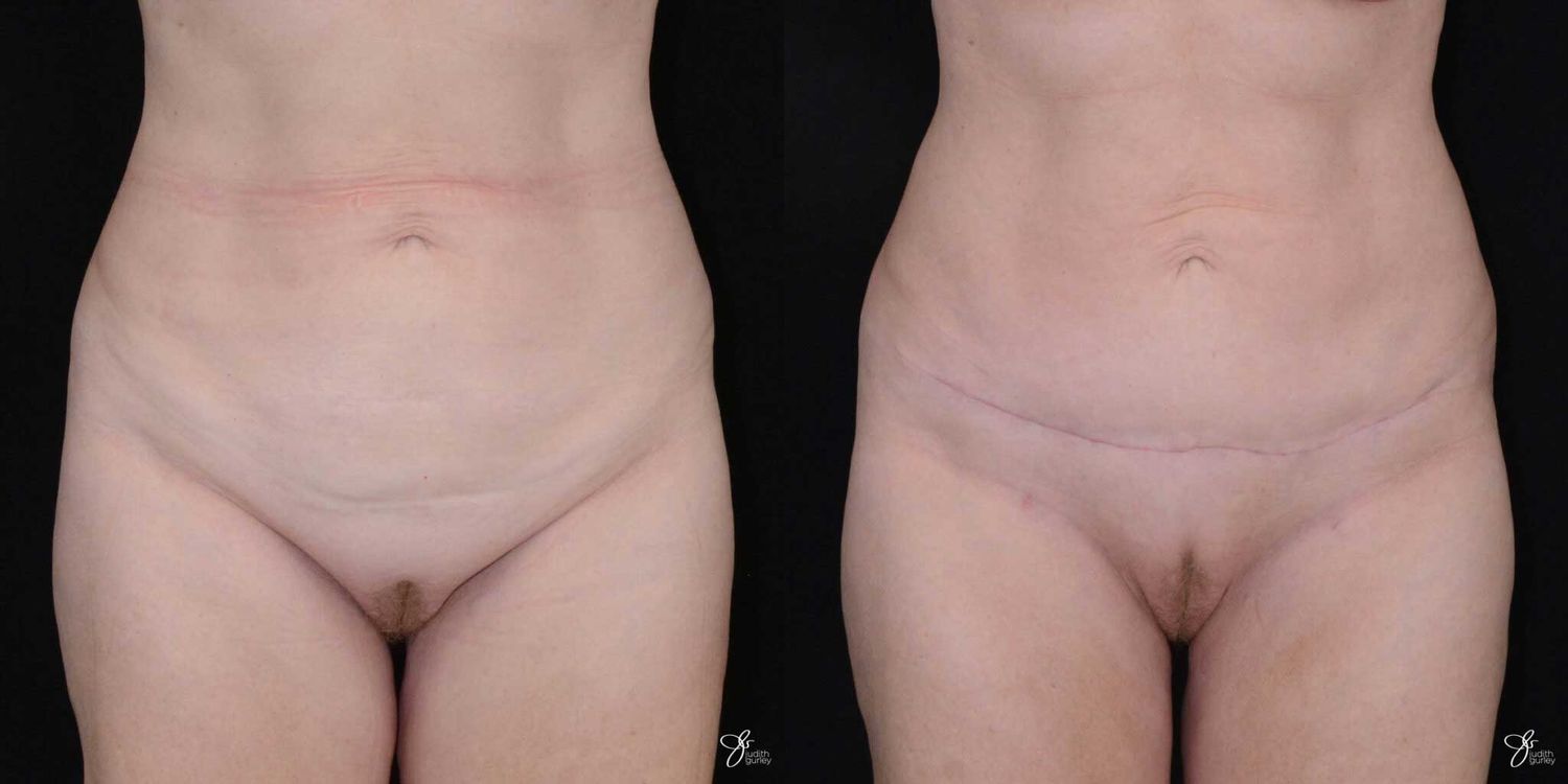 C Section Scar Correction Before & After