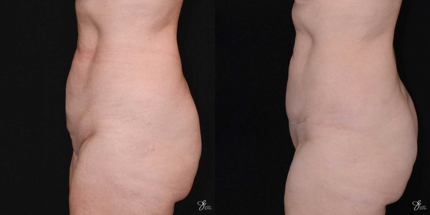 C Section Scar Correction Before & After