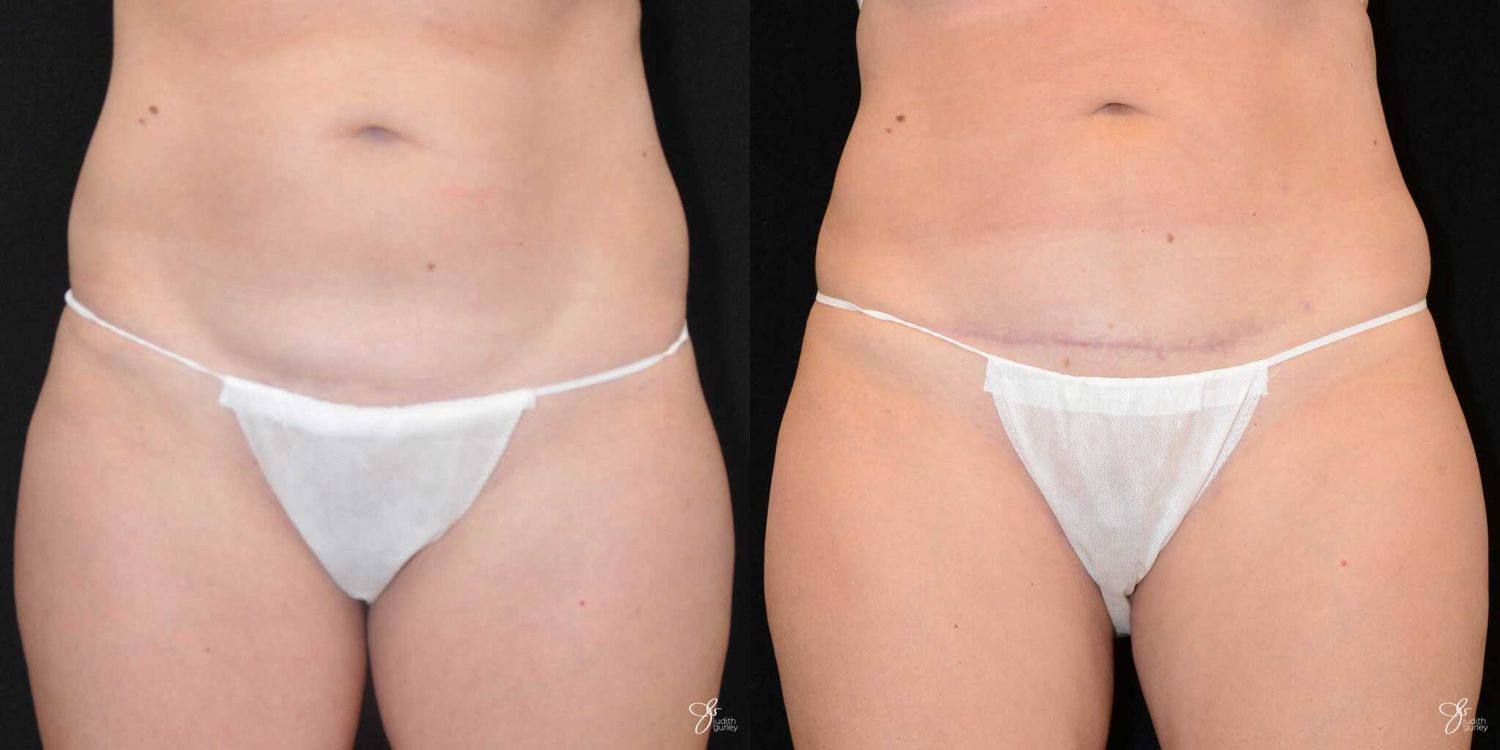 C Section Scar Correction Before & After