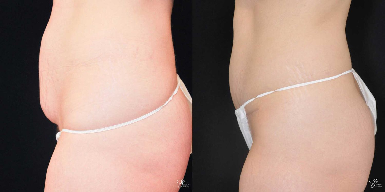 C Section Scar Correction Before & After