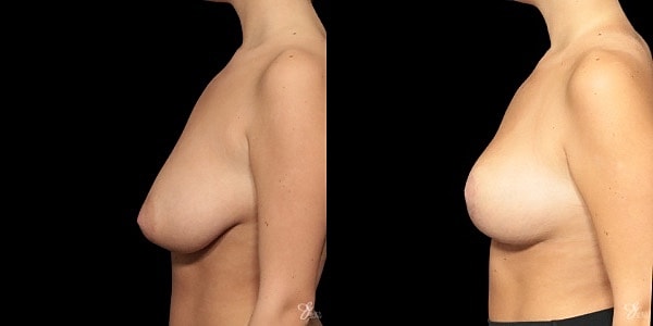 Adolescent Breast Correction Before & After