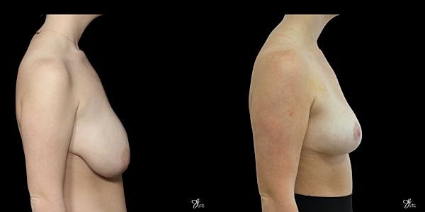 Adolescent Breast Correction Before & After