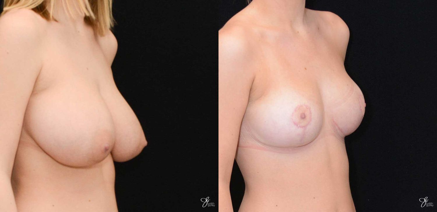 Adolescent Breast Correction Before & After