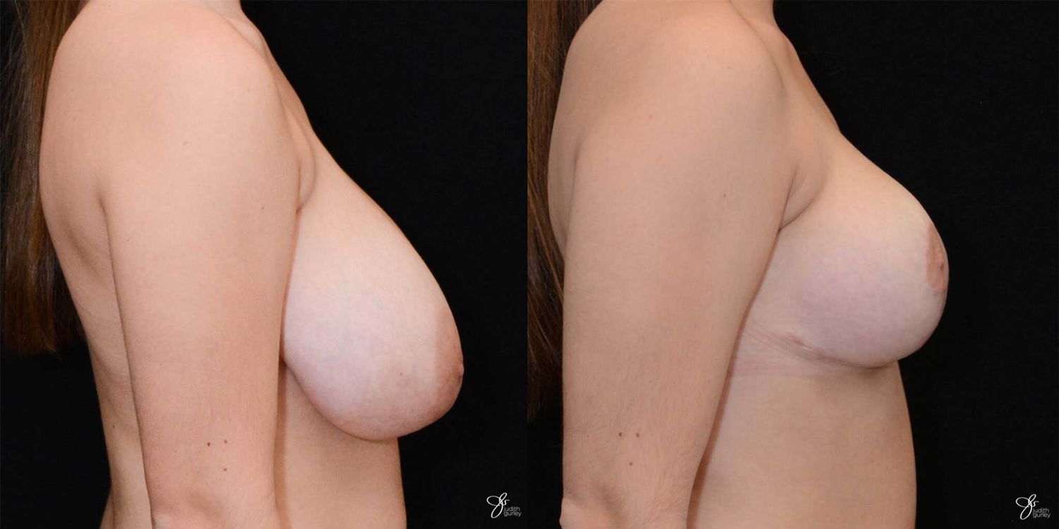 Adolescent Breast Correction Before & After