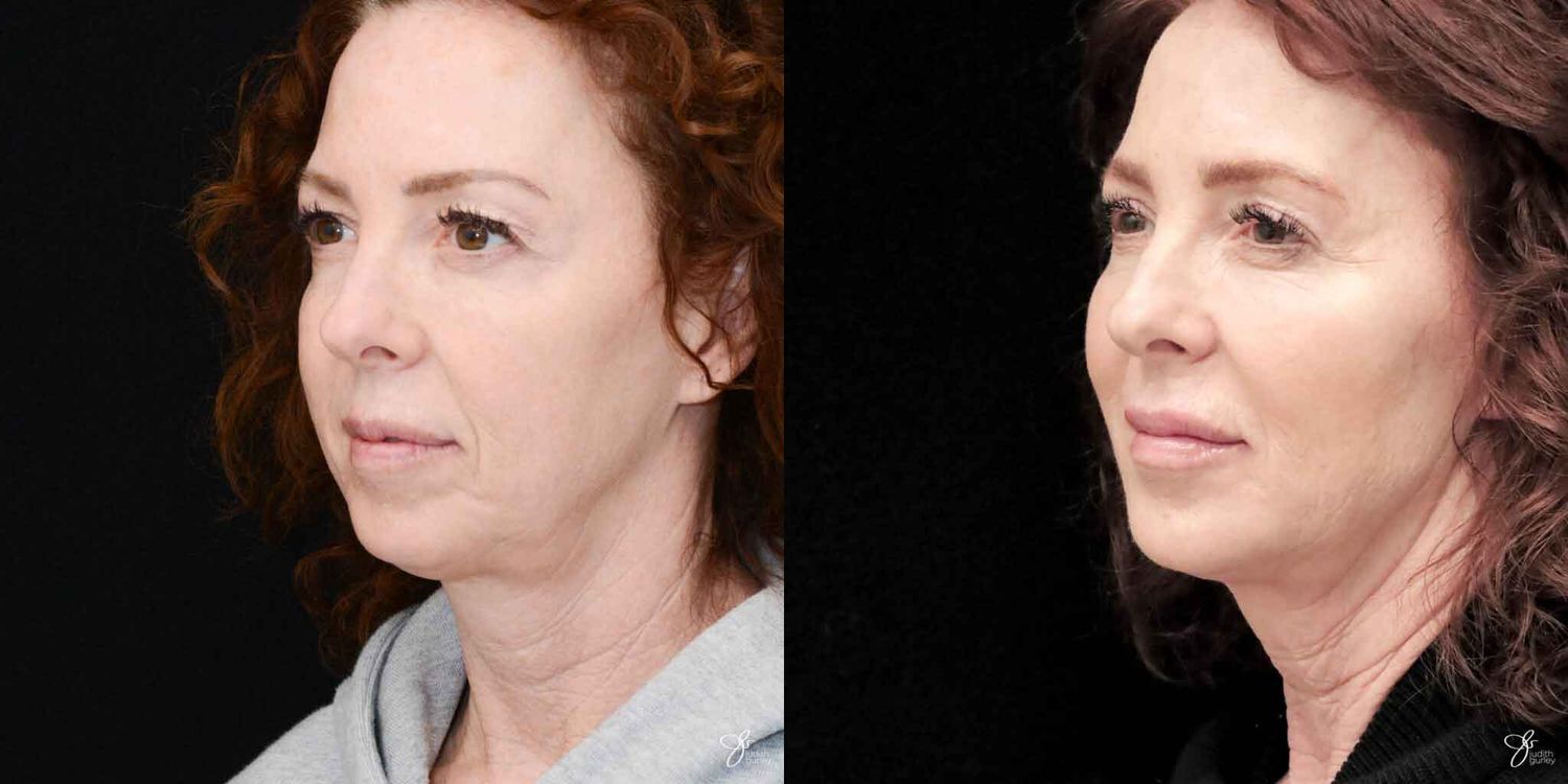 Facial Fat Grafting Before & After