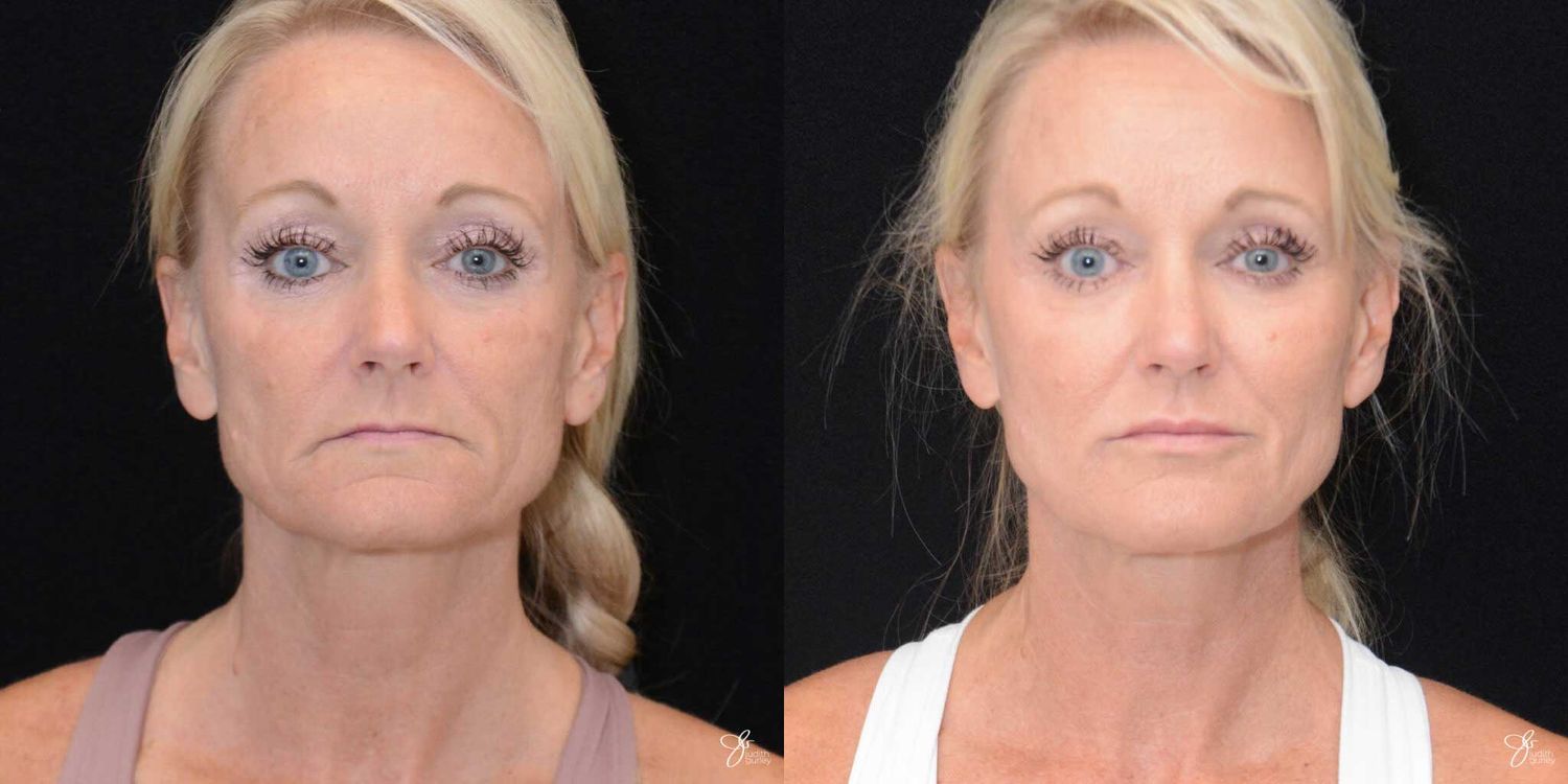 Facial Fat Grafting Before & After