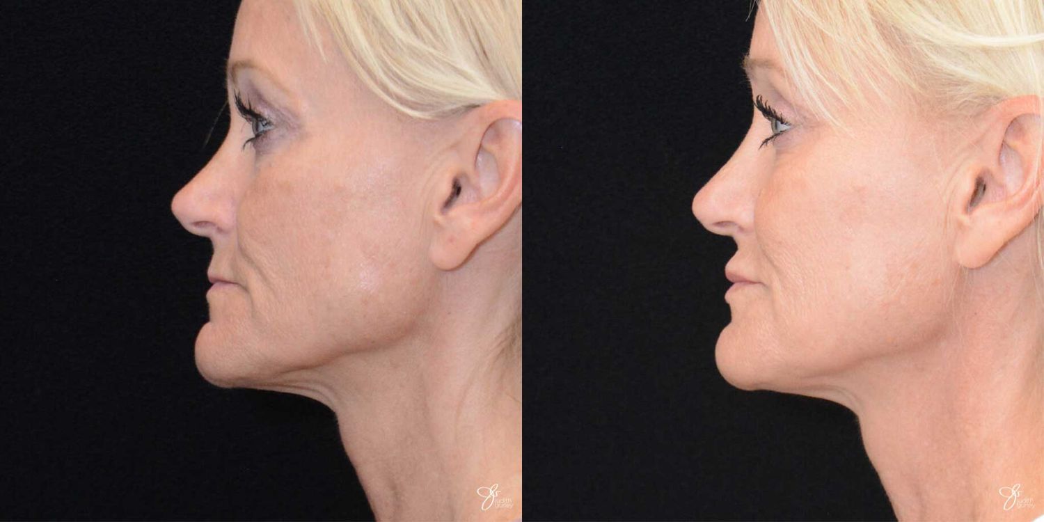 Facial Fat Grafting Before & After