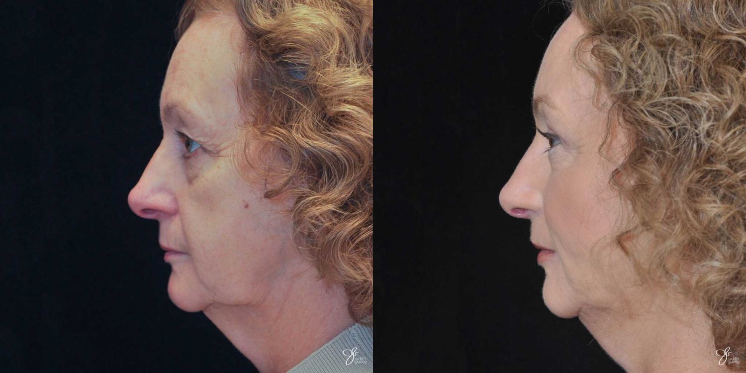 Facial Fat Grafting Before & After