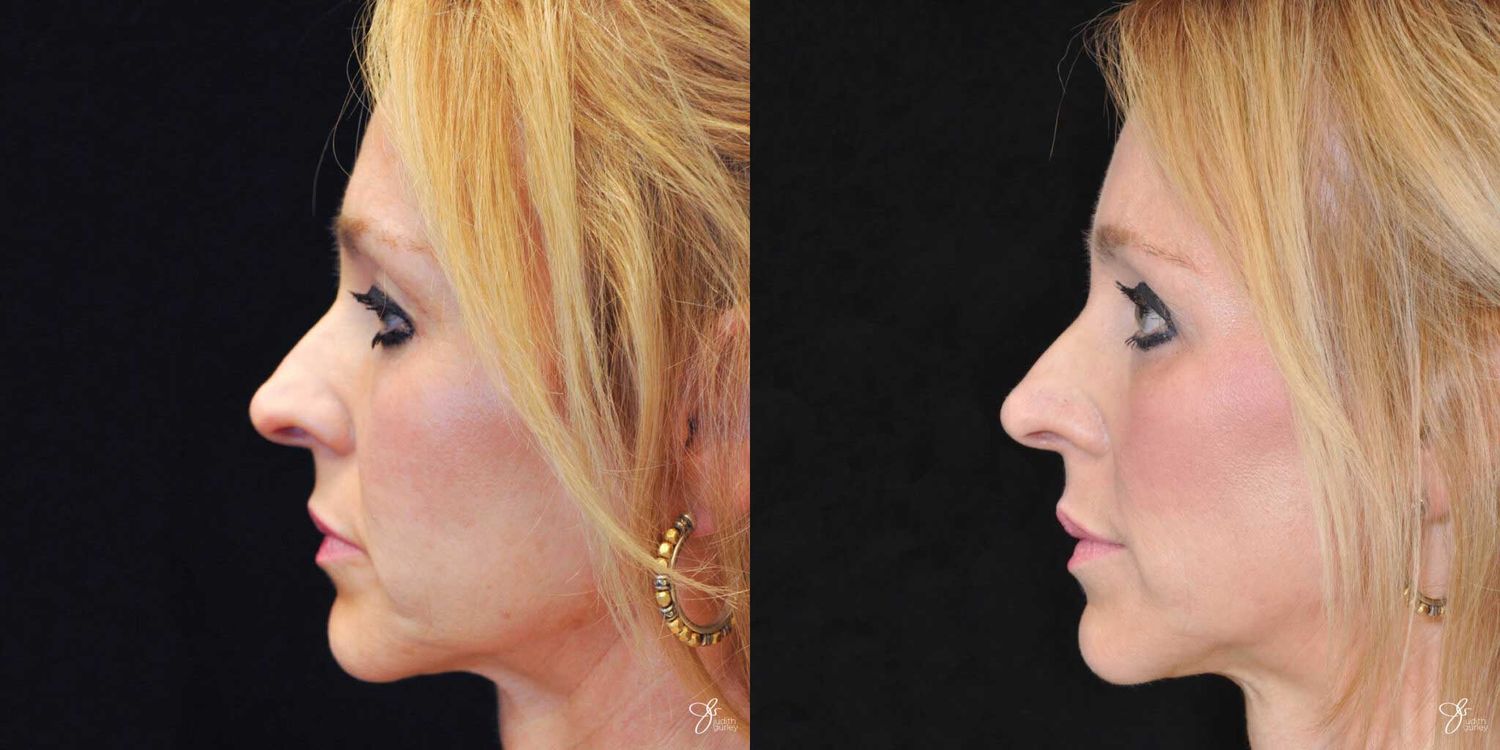 Facial Fat Grafting Before & After