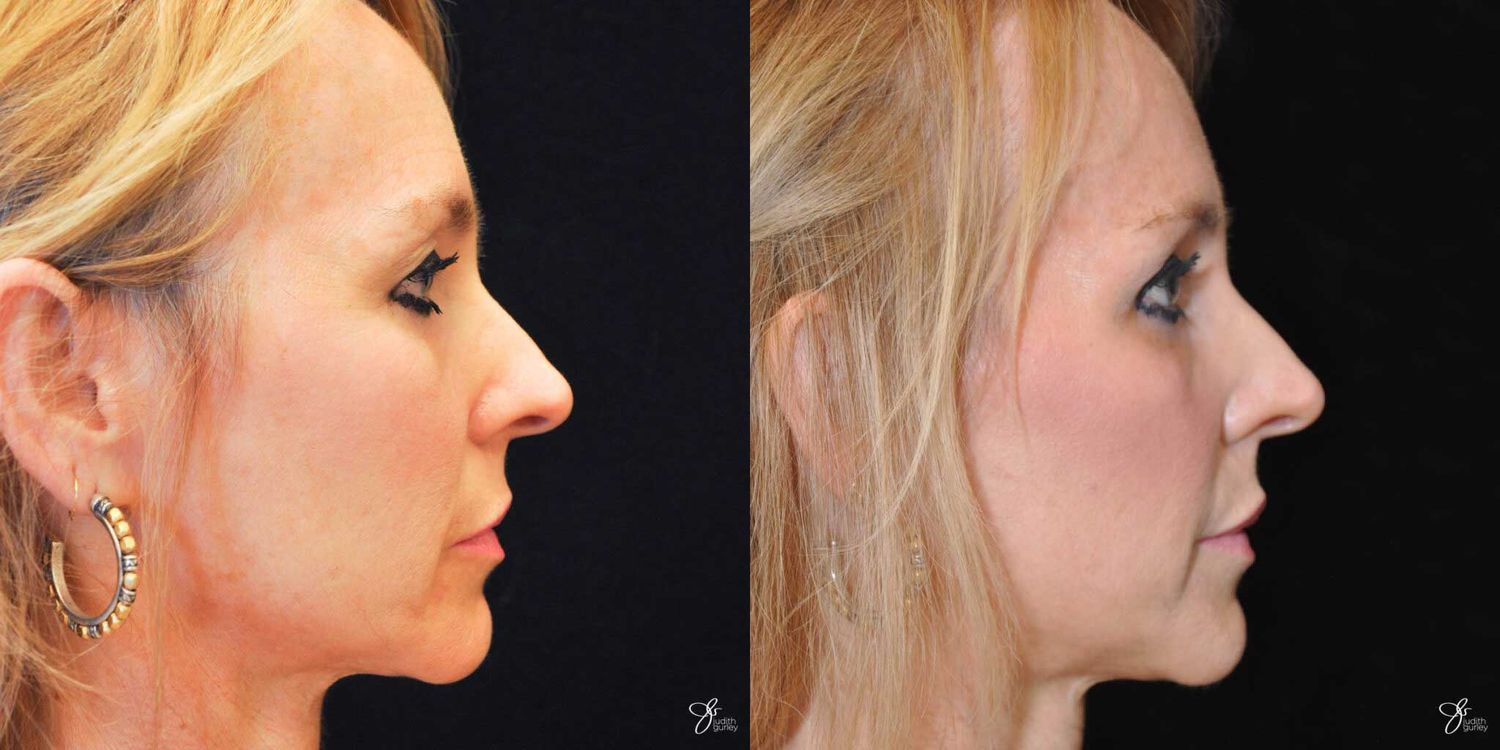 Facial Fat Grafting Before & After