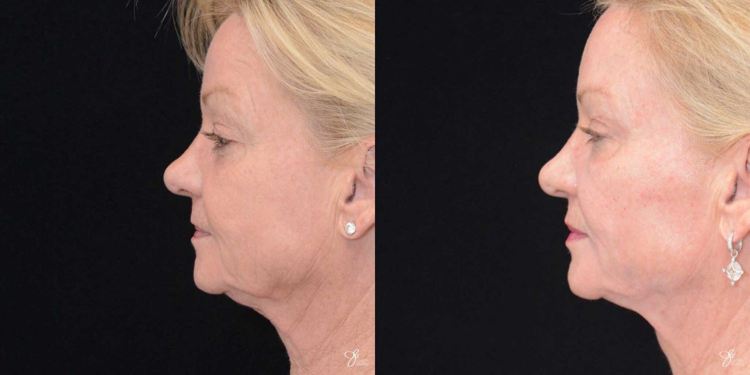 Facial Fat Grafting Before & After