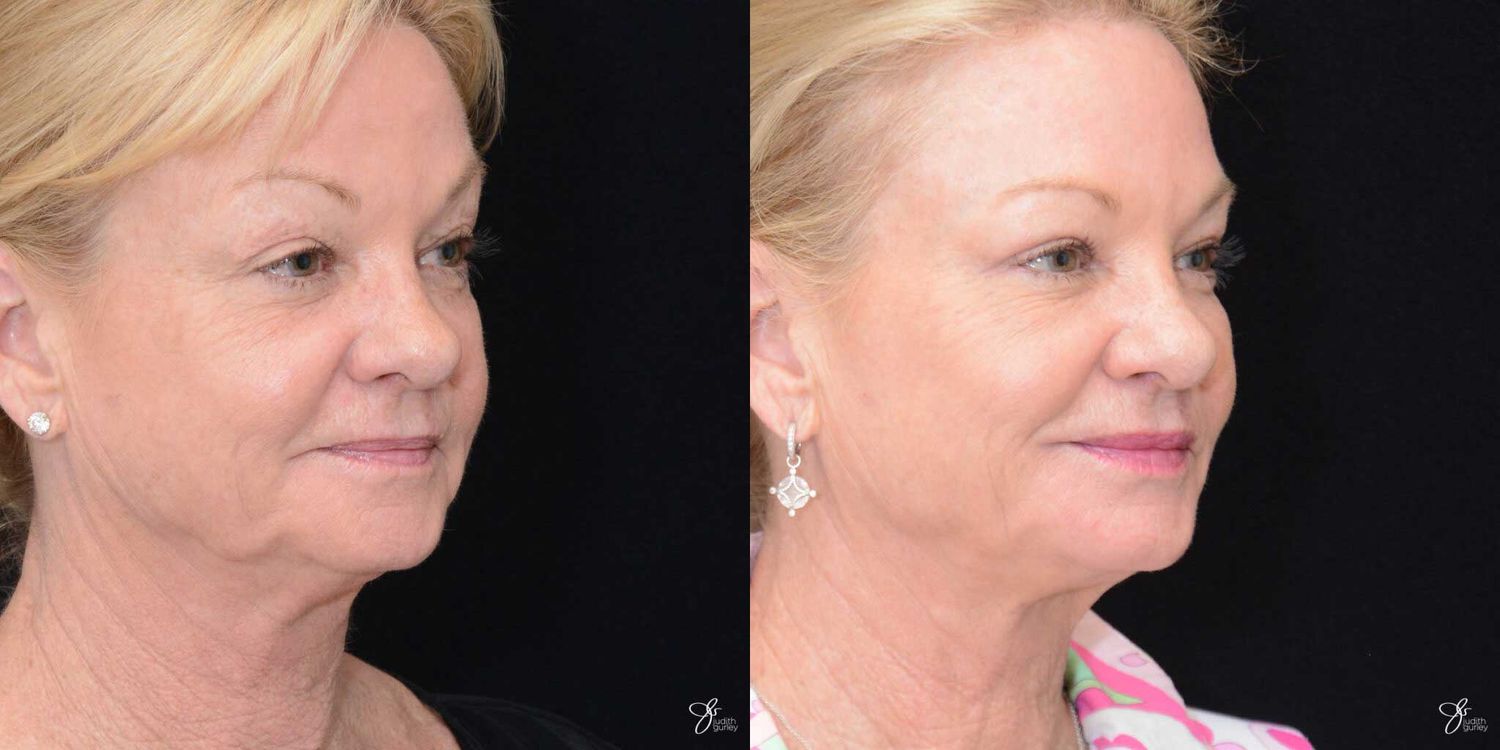 Facial Fat Grafting Before & After
