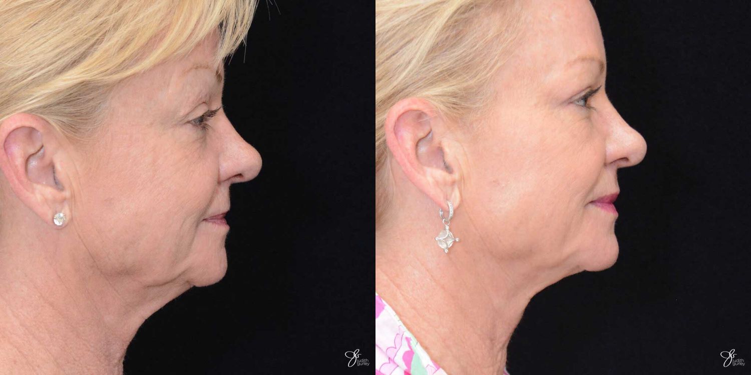 Facial Fat Grafting Before & After