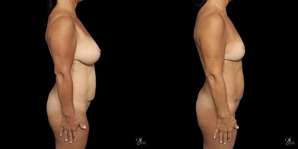 Mommy Makeover Before & After