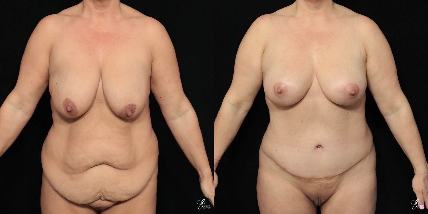 Mommy Makeover Before & After