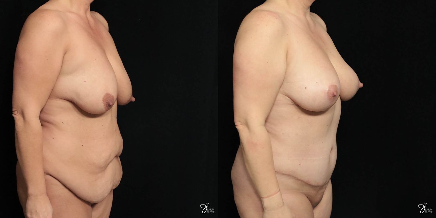 Mommy Makeover Before & After