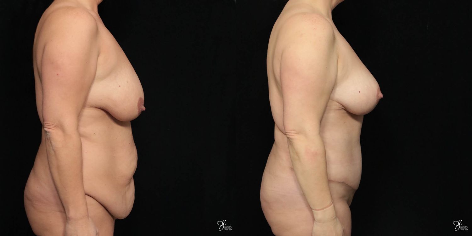 Mommy Makeover Before & After